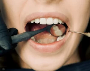 Wisdom Tooth Stitches: Categories&Healing Time