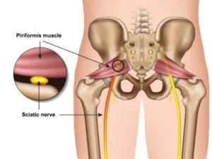 6 Top Yoga Poses for Relieving Piriformis Syndrome